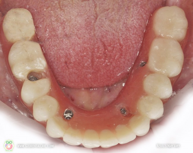 gio-dental-implants--implan-gigi
